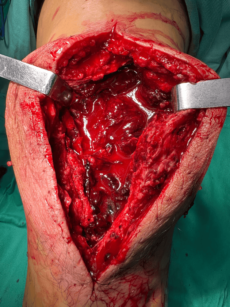 Large postoperative haematoma in the open knee wound at second-look surgery, held open by two retractors