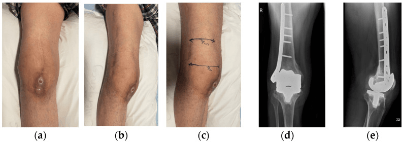 Three clinical views of a small anterior knee wound, one with ink markings, and AP and lateral radiographs of a right knee replacement with a plate on the distal femur