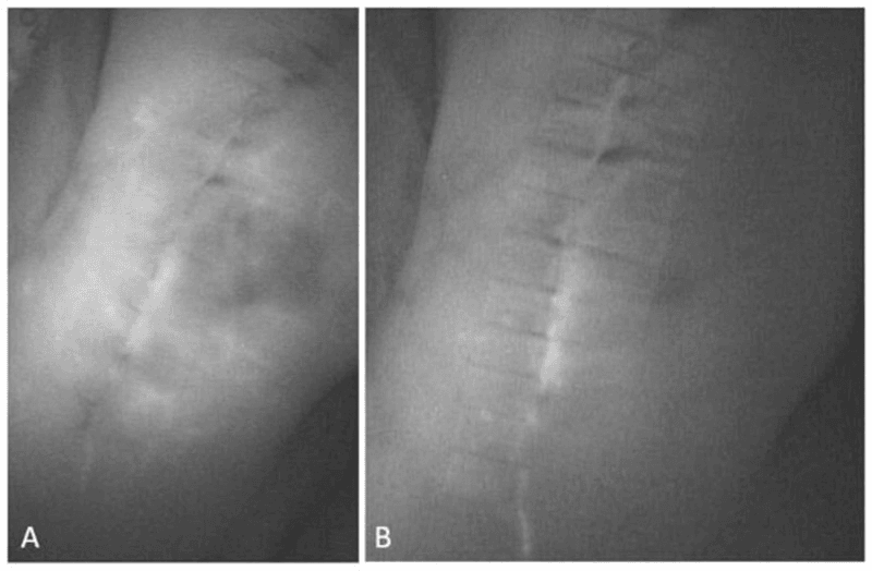 Fluorescence angiography of a closed knee incision, panels A and B, before and after posterior icing