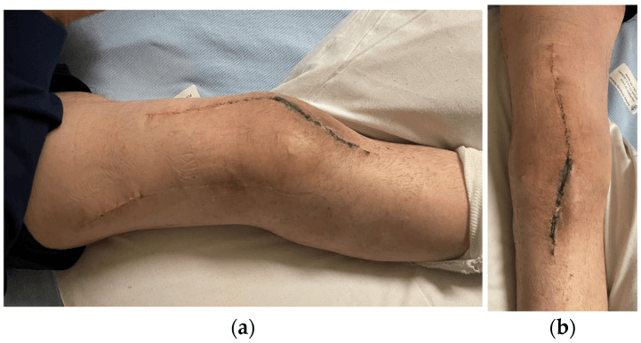 Side and front views of a leg with a long closed incision over the knee after soft-tissue reconstruction