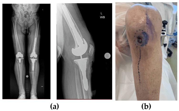 Long-leg AP and weight-bearing lateral radiographs of bilateral knee replacements, stemmed on the left, and a clinical photograph of an anterior knee wound outlined in ink