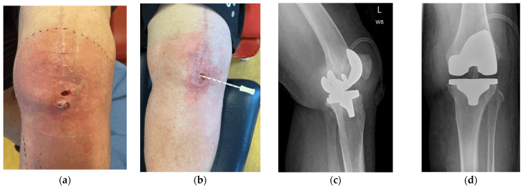 Erythematous anterior knee with a midline scar and an open wound, a probe passed into the wound, and lateral and AP radiographs of the knee replacement beneath