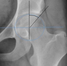 Lateral centre-edge angle of Wiberg measured on a hip radiograph - a circle fitted to the femoral head, a vertical line through its centre, and a line to the lateral acetabular edge
