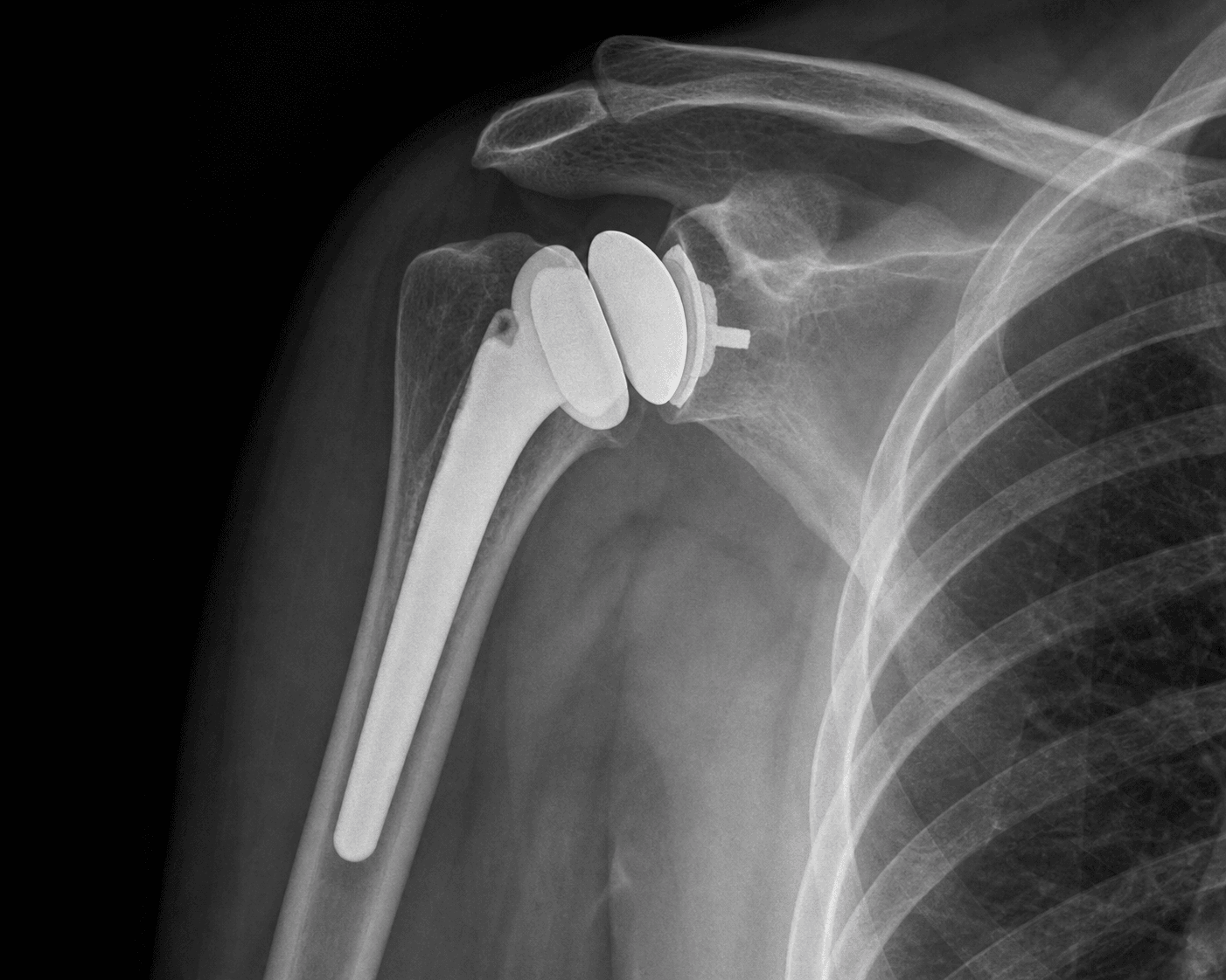 AP radiograph of an anatomic total shoulder arthroplasty with a stemmed humeral head component and a glenoid component.