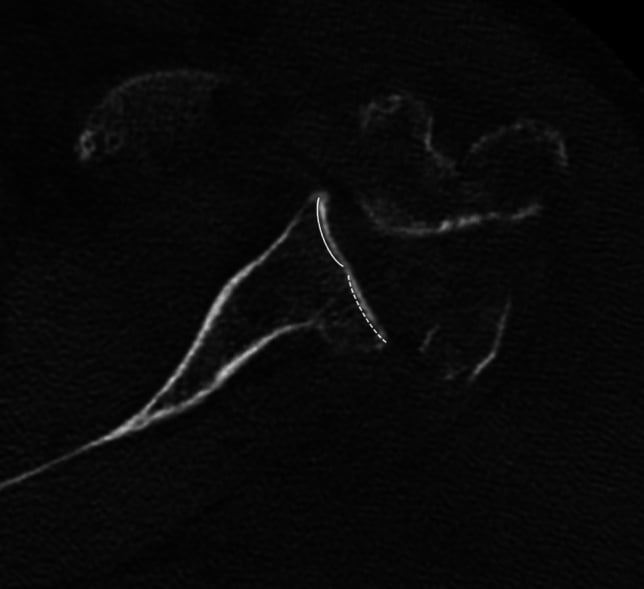 Axial CT showing a Walch B2 biconcave glenoid with posterior wear
