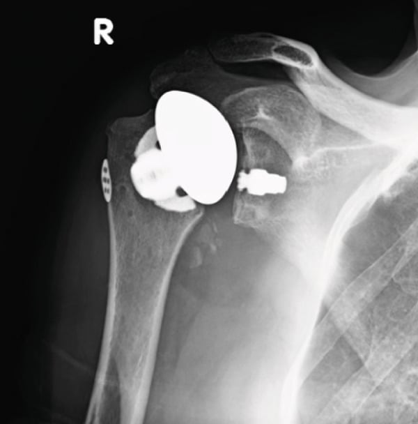 Postoperative AP radiograph of a stemless anatomic total shoulder arthroplasty