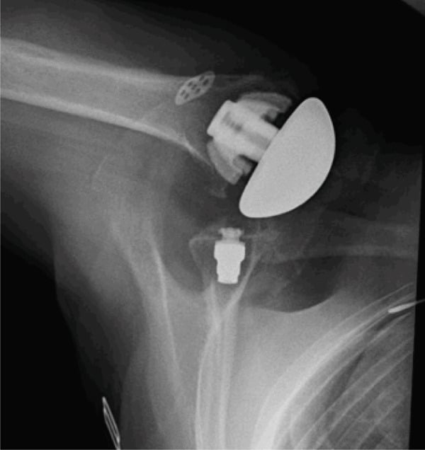 Radiograph showing anterior dislocation of a stemless anatomic shoulder arthroplasty