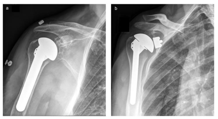 Radiographs comparing cemented all-polyethylene and trabecular-metal-backed glenoid components in anatomic TSA