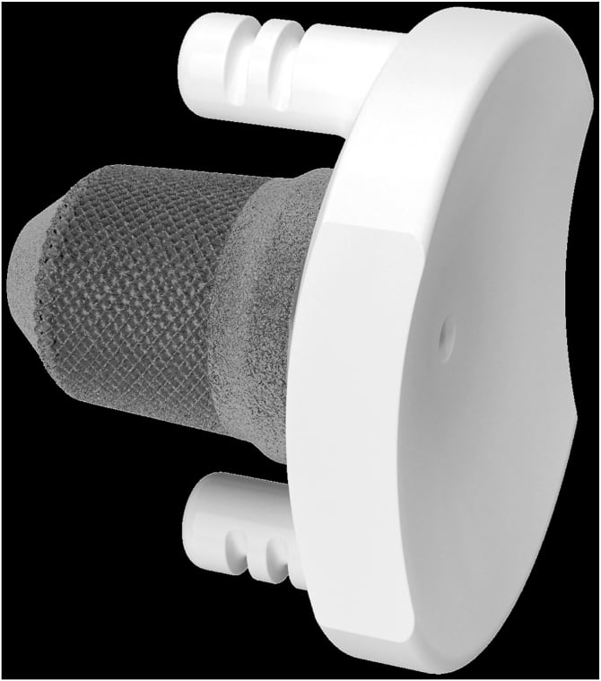 Hybrid all-polyethylene glenoid component with porous central peg and cemented peripheral pegs