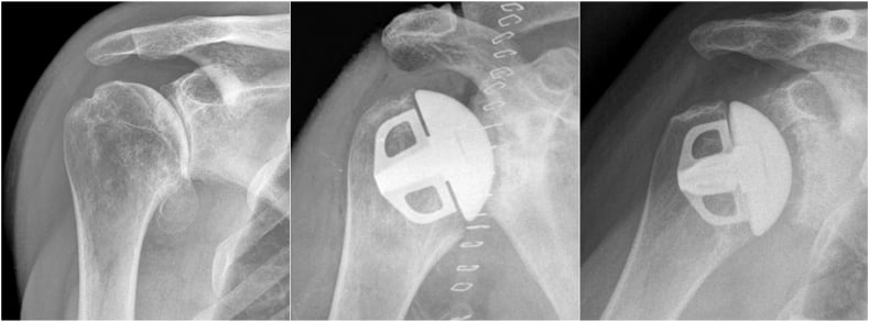 Preoperative immediate postoperative and ten-year radiographs of a stemless anatomic TSA