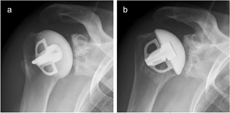 True AP radiographs in internal and external rotation showing projection-dependent glenoid radiolucency