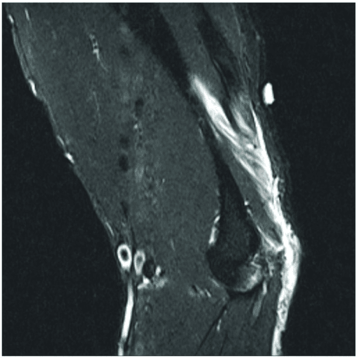Sagittal fat-saturated MRI of the elbow showing the distal triceps musculotendinous unit
