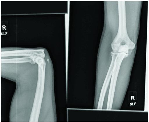 Lateral and AP radiographs of a right elbow used to look for the fleck sign of triceps avulsion