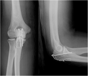 Postoperative AP and lateral radiographs showing transosseous bone-tunnel triceps repair