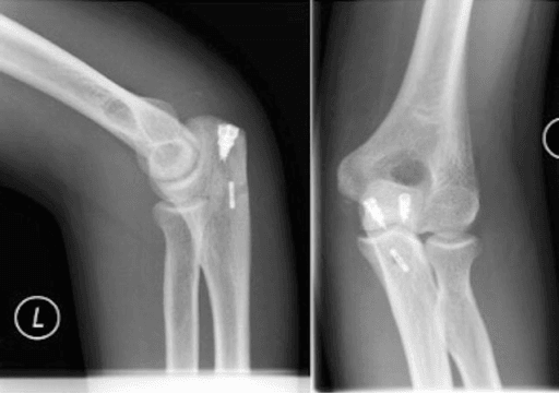 Postoperative AP and lateral radiographs showing intramedullary cortical button triceps fixation