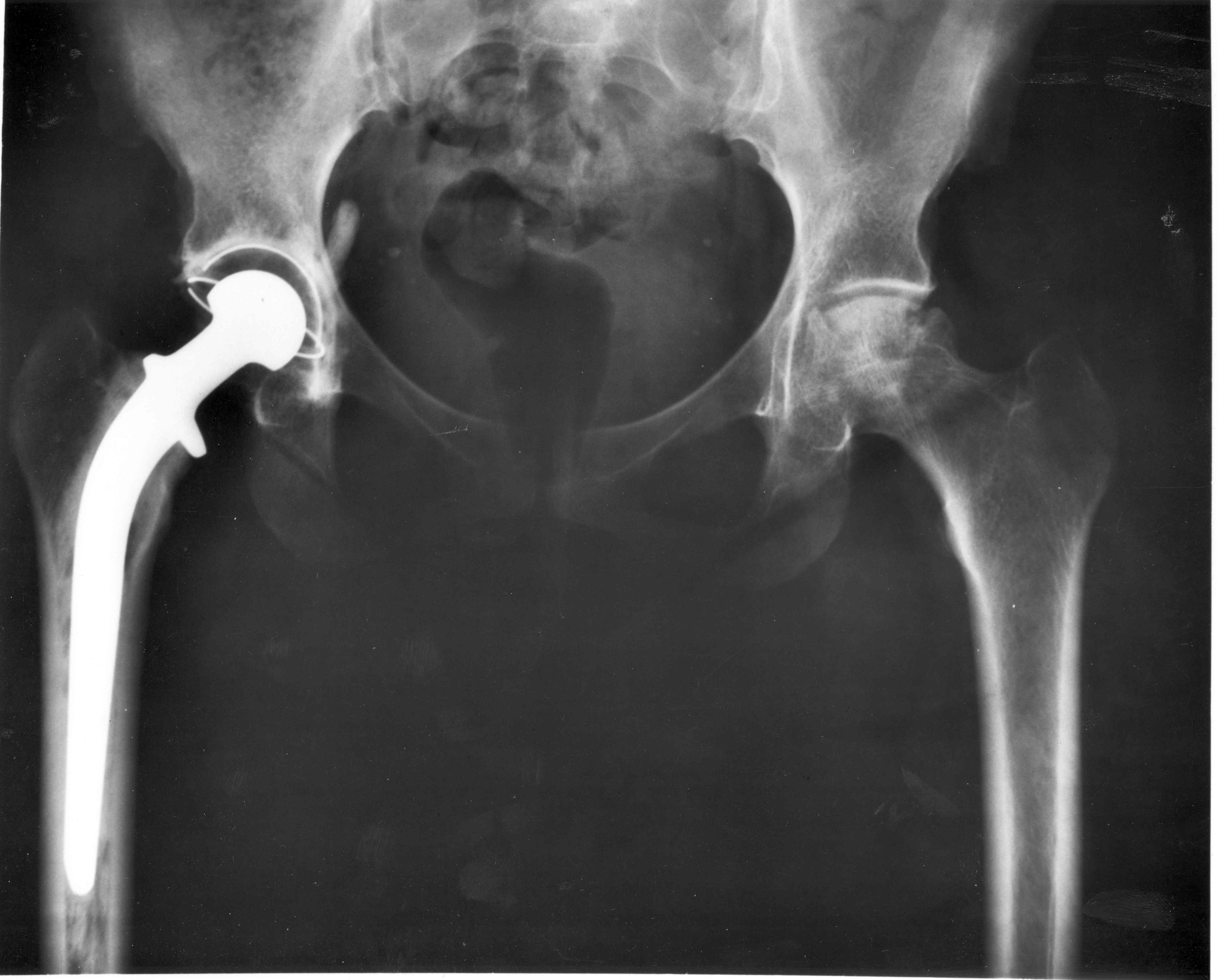AP pelvic radiograph showing a total hip replacement, used to assess the components in suspected trunnionosis.