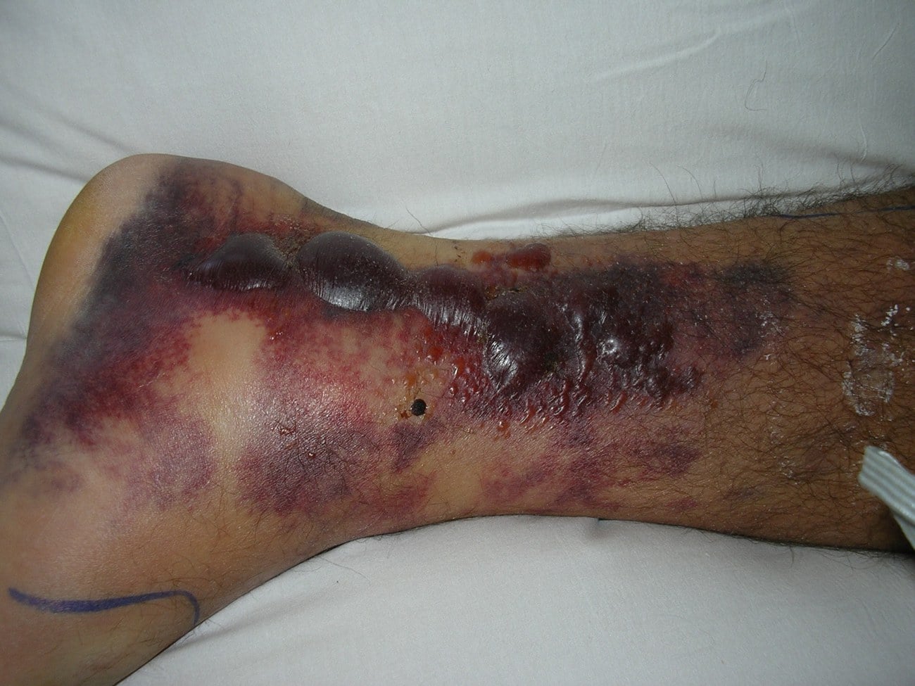 Clinical photograph of haemorrhagic fracture blisters and bruising over the ankle indicating a severe closed soft-tissue injury.