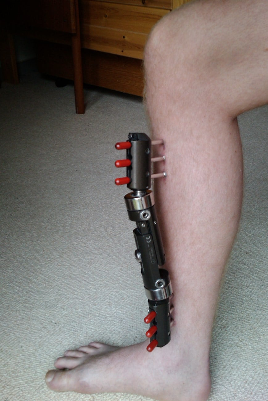 Lower leg with a monolateral external fixator applied to the tibia, illustrating temporary spanning fixation.