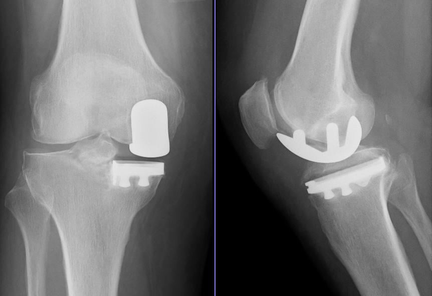AP and lateral radiographs of a medial unicompartmental knee prosthesis with the lateral and patellofemoral compartments preserved.