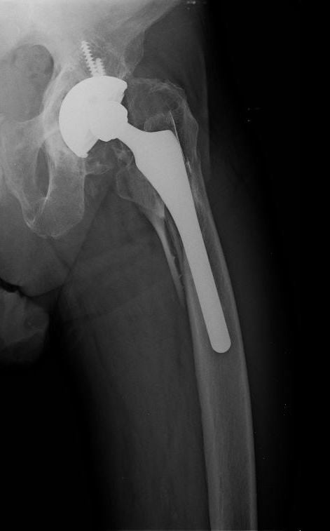 AP radiograph of a left total hip arthroplasty with a periprosthetic femoral fracture around the femoral stem.