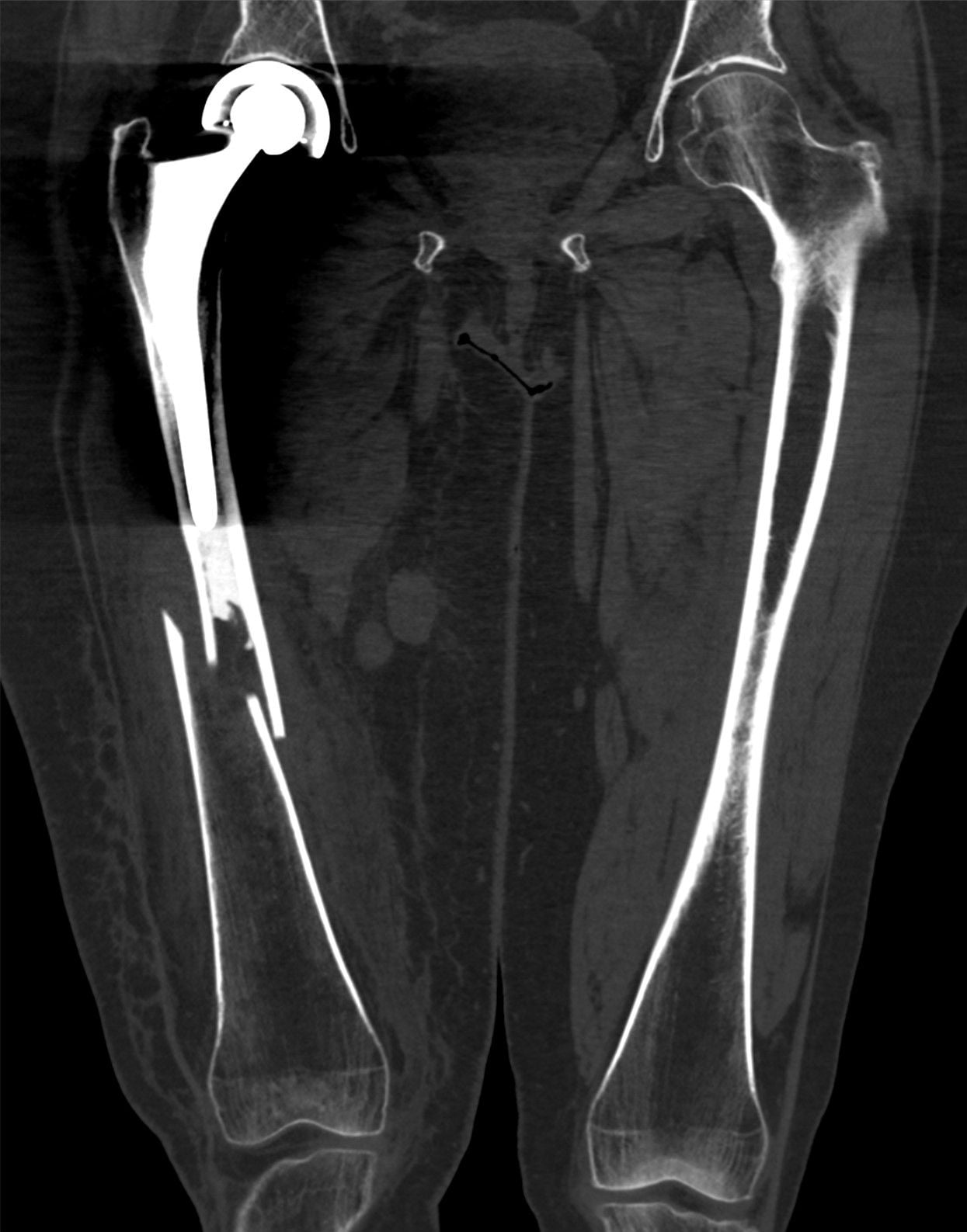 Coronal CT of both femora showing a periprosthetic femur fracture well below a hip arthroplasty stem on the left.