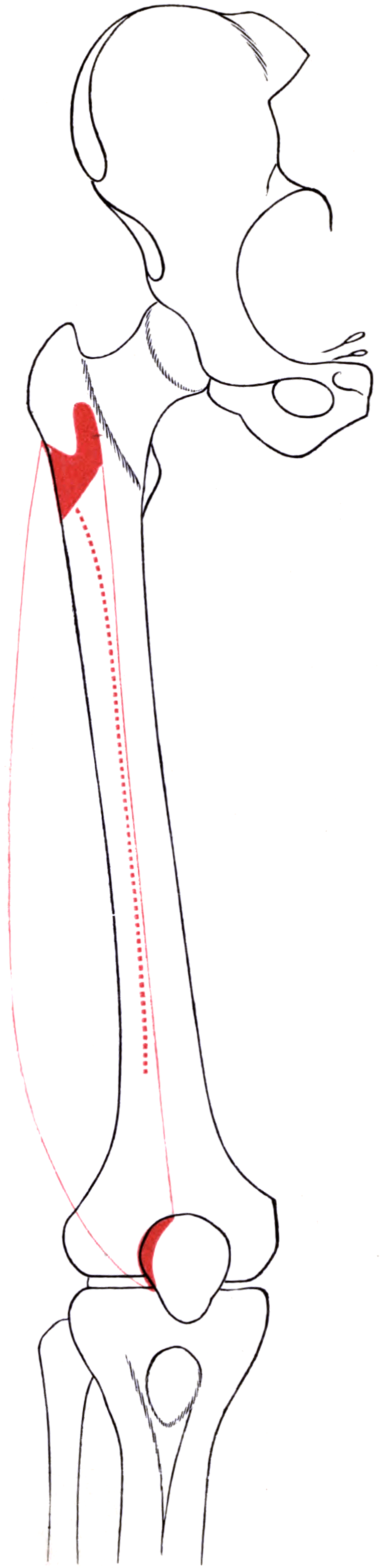 Public-domain outline of the right lateral femur with vastus lateralis attachment areas marked in red.