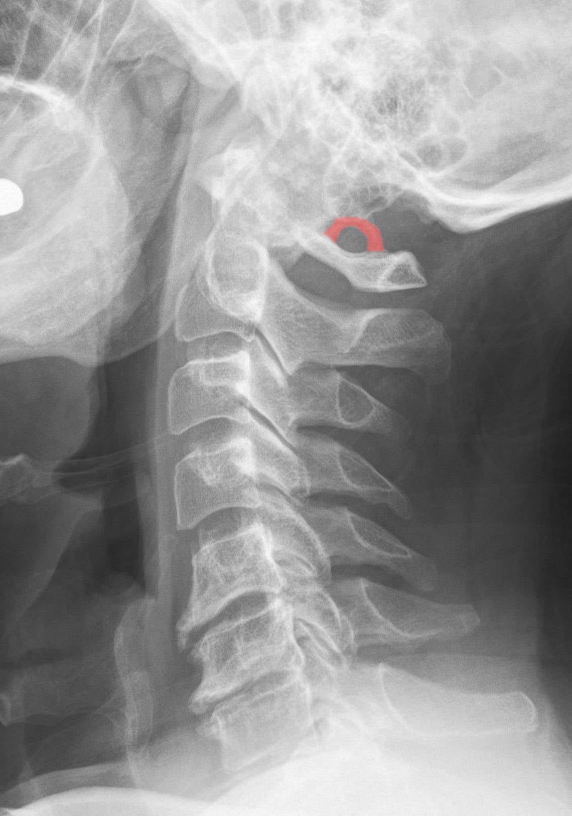 Lateral cervical radiograph with a complete ponticulus posticus, a bony ring over the C1 posterior arch labelled in German as complete.