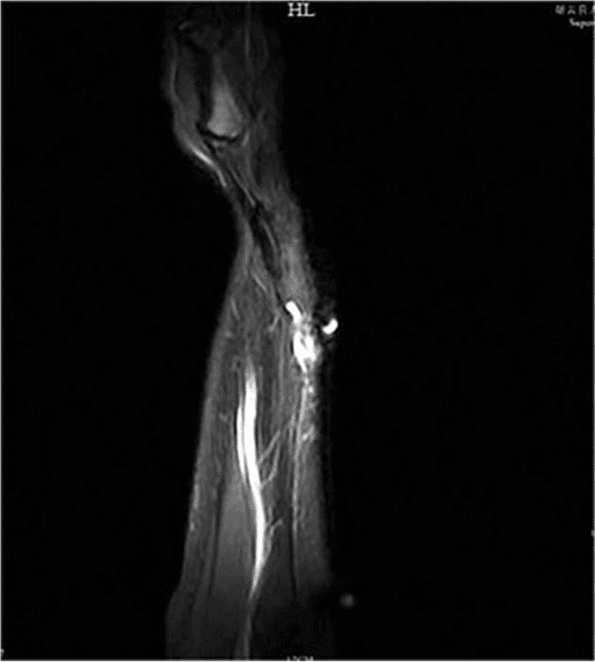 Fluid-sensitive MRI of the forearm showing a long bright linear structure with a brighter irregular focus beside it