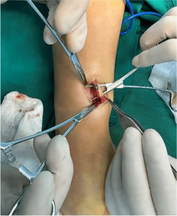 Operative exploration of the forearm through a short incision held open with clamps and forceps