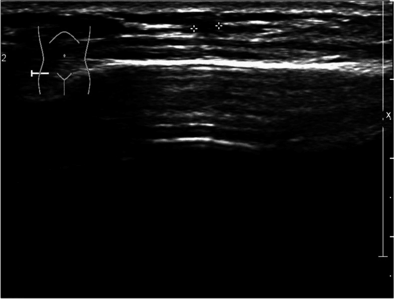 Ultrasound of the symptomatic distal forearm with callipers marking a small superficial structure
