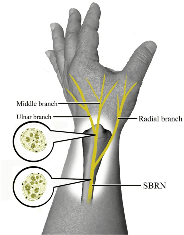 Diagram of the distal SBRN dividing into radial, middle and ulnar branches over the dorsum of the hand, with fascicular cross-section insets