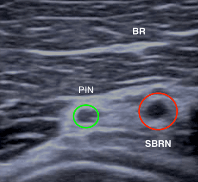 Ultrasound with the SBRN circled in red beside the posterior interosseous nerve circled in green, deep to brachioradialis