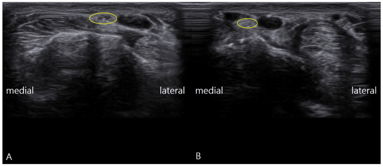 Paired transverse ultrasound, panels A and B, with the superficial radial nerve outlined by a yellow ellipse and medial and lateral marked
