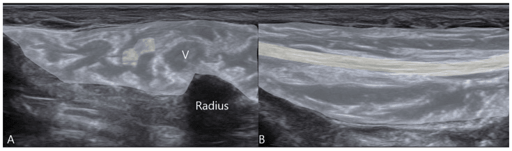 Short- and long-axis ultrasound after SBRN hydrodissection, the nerve highlighted inside shaded perineural fluid