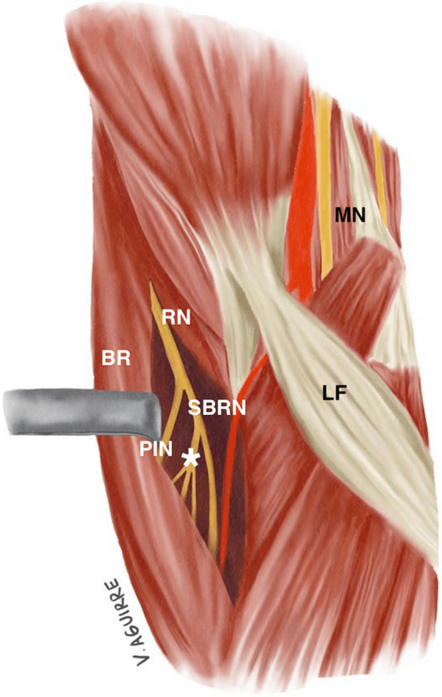 Illustration of the proximal forearm with brachioradialis retracted, showing the radial nerve dividing into the posterior interosseous nerve and the SBRN