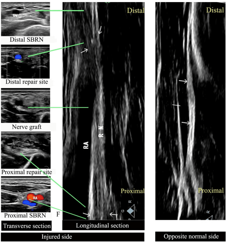 Serial transverse and longitudinal ultrasound of a reconstructed SBRN at follow-up, compared with the opposite normal side