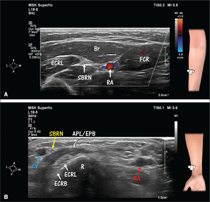 Two-panel ultrasound: in the forearm the SBRN lies near the radial artery, and at the wrist it lies near the cephalic vein