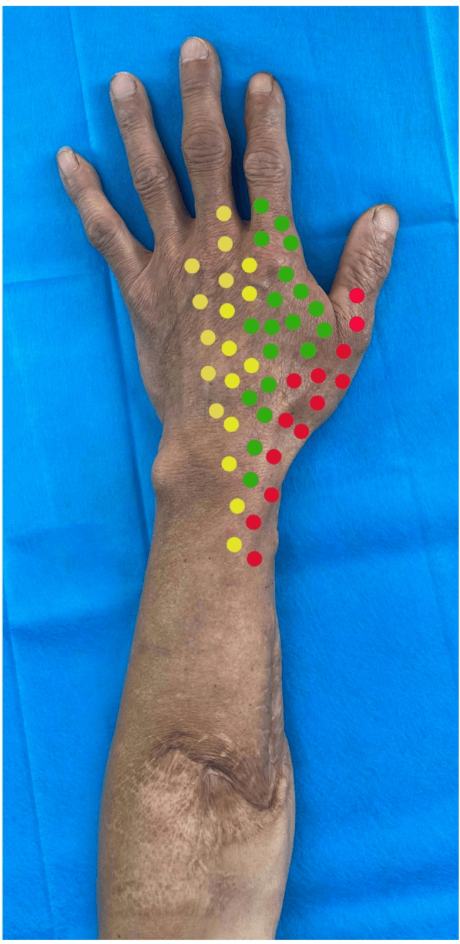 Dorsum of a hand and wrist with sensory test points marked as yellow, green and red dots