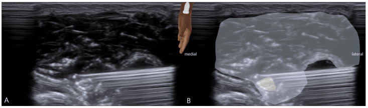Two-panel ultrasound from an SBRN hydrodissection, panel B with shaded overlays, medial and lateral marked and a forearm inset