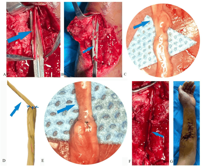 Seven-panel figure, A to G, of microsurgical split homolateral graft reconstruction of an SBRN defect