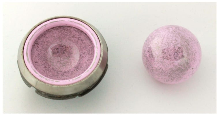 Retrieved ceramic femoral head and ceramic liner seated in its metal shell, both with widespread dark metallic deposition.