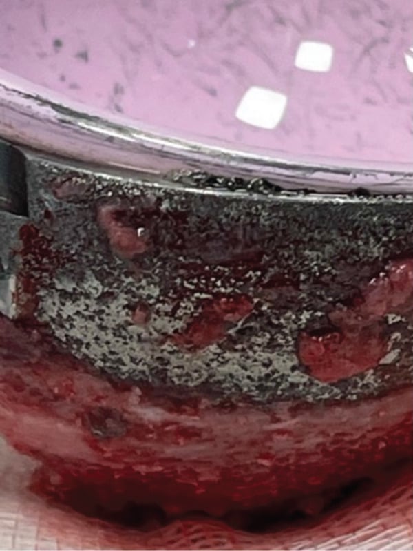 Operative close-up showing extensive dark metal residue from taper corrosion on the metal beneath a pink ceramic surface of a hip implant.