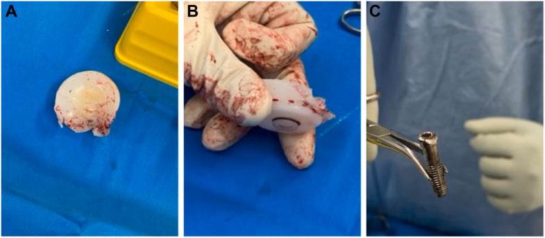 Three operative photographs (A-C): a retrieved polyethylene liner with a destroyed rim, the same liner held in a gloved hand, and a locking screw held in forceps.