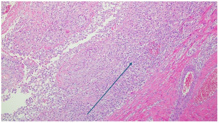 Low-power H&E histology, an arrow marking a dense chronic macrophage-rich inflammatory infiltrate around an arthroplasty.