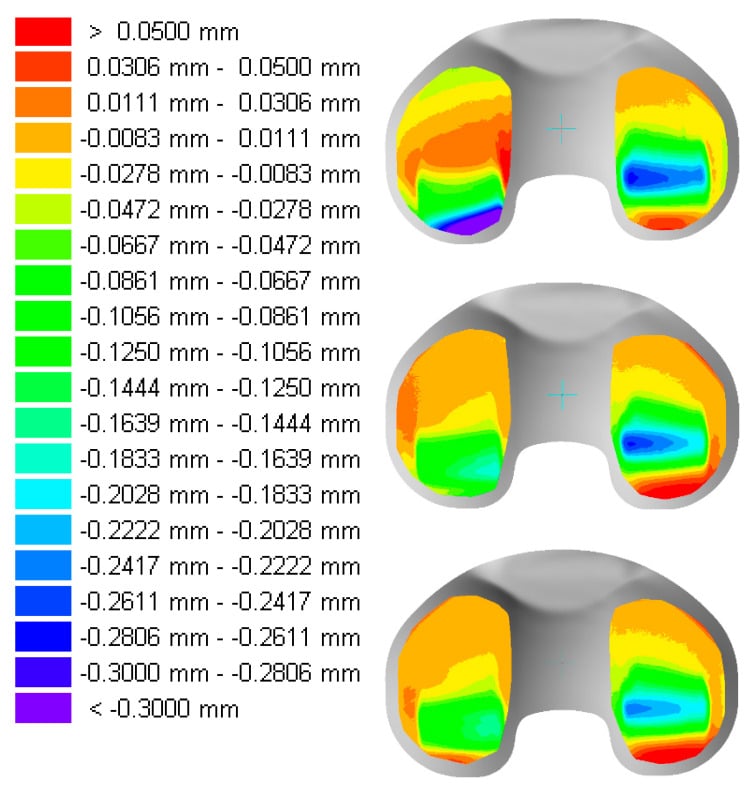 Colour deviation maps of three tibial polyethylene inserts, with a legend running from above 0.05 mm to below -0.30 mm, showing the distribution and depth of wear across both condyles.