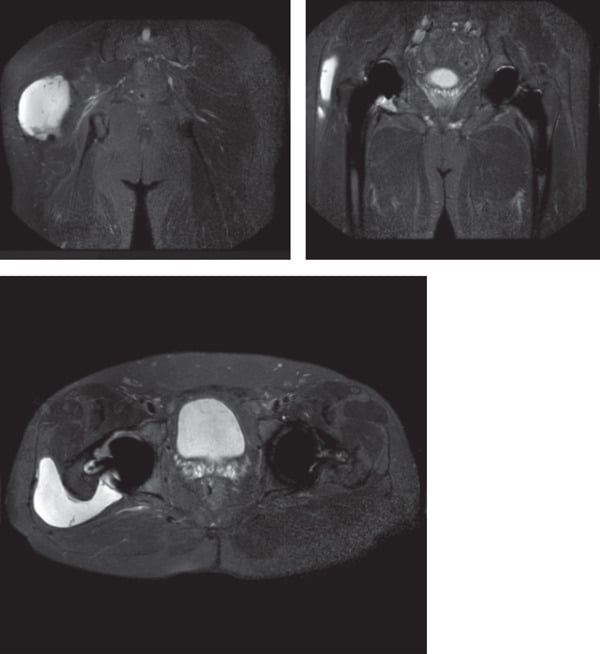 Hip MRI, two coronal images and one axial, showing a large fluid collection beside the patient's right hip arthroplasty (image left), extending posteriorly on the axial image, in trunnionosis.