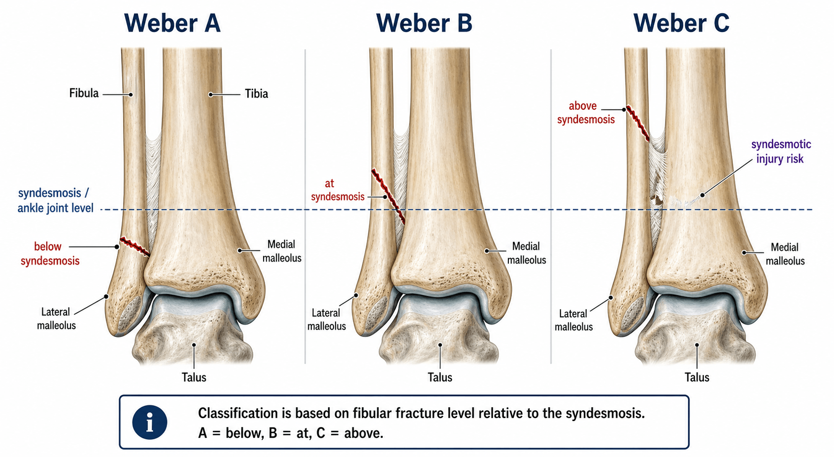 Weber (Danis-Weber) ankle fracture classification: A below, B at, C above the syndesmosis