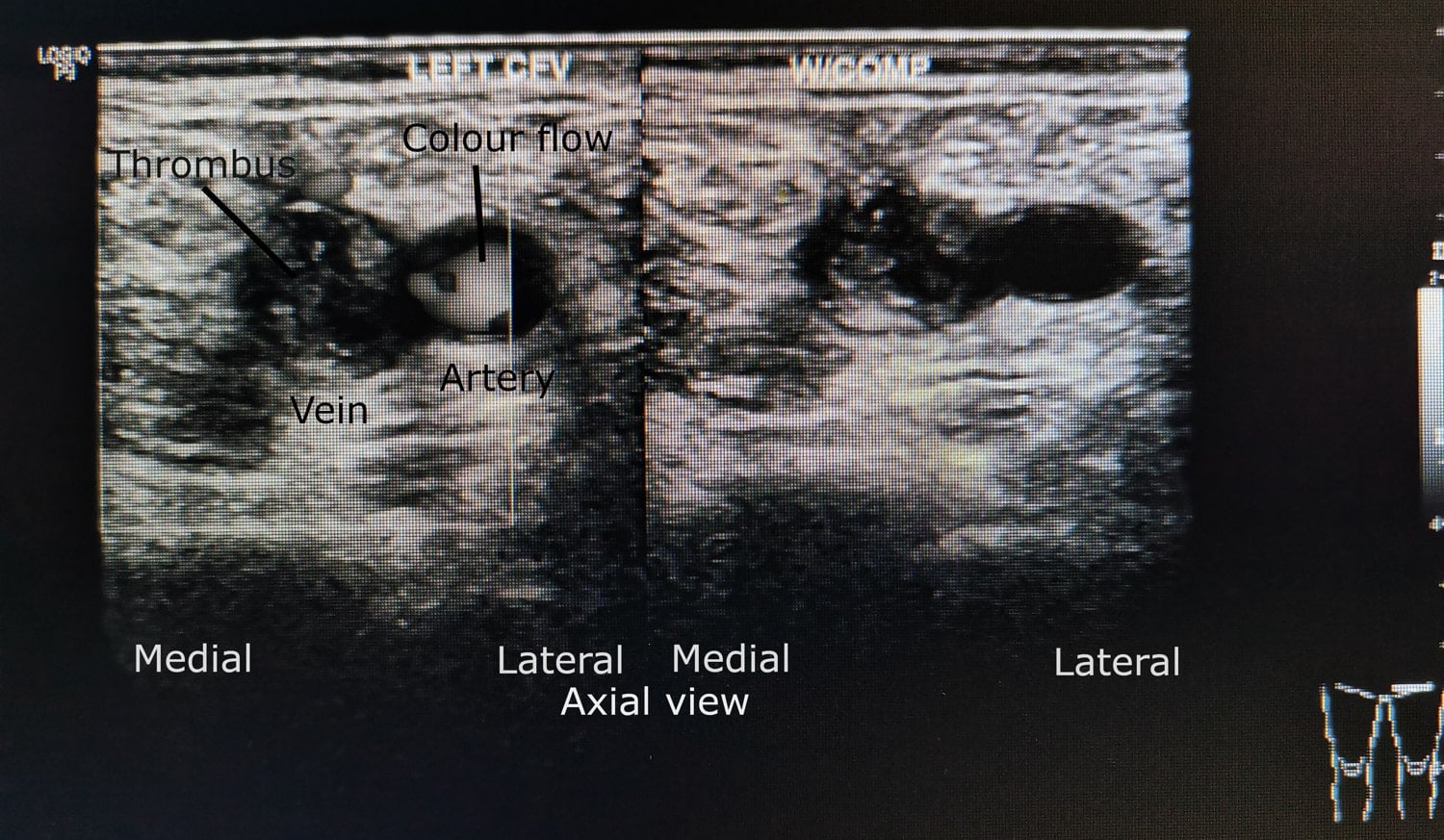 Axial duplex ultrasound of the common femoral vein showing echogenic thrombus filling the vein lumen with colour flow in the adjacent artery