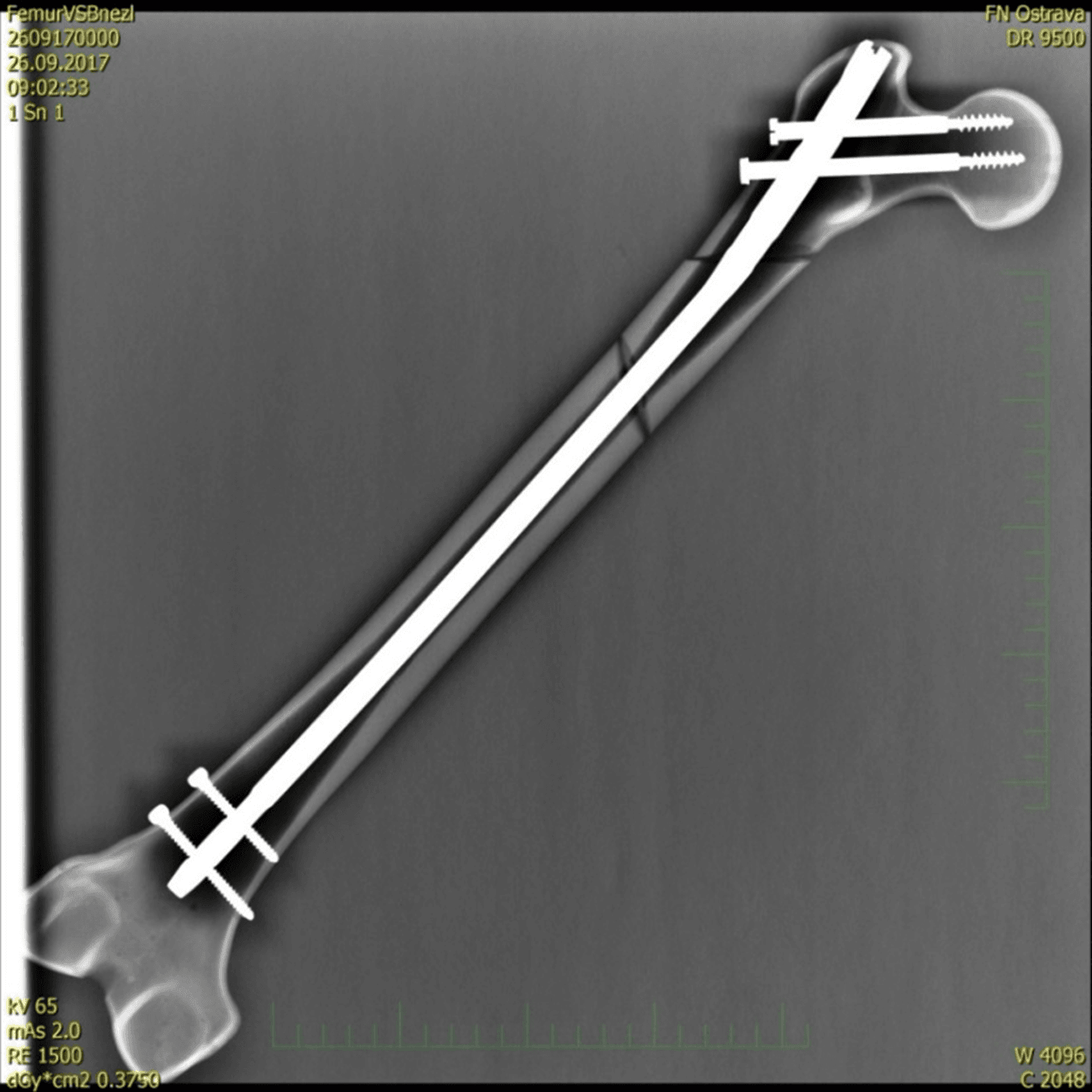 Radiograph of a long statically-locked intramedullary femoral nail with proximal and distal interlocking screws