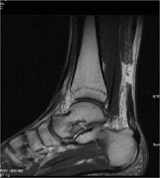 Clinical photograph demonstrating the Thompson (Simmonds) test being performed on a patient with acute Achilles tendon rupture. With the patient prone and feet over the edge of the bed, squeezing the calf fails to produce plantar flexion of the foot (positive test). A palpable gap is visible 4-6cm proximal to the calcaneal insertion, with bruising over the posterior ankle.